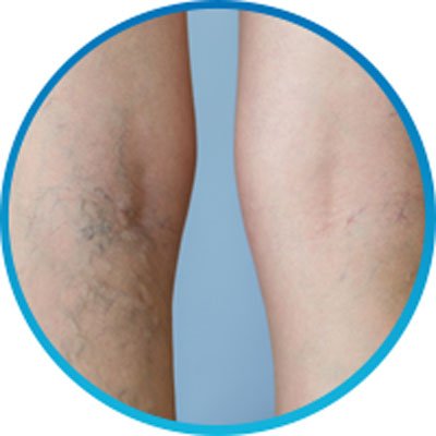 Laser Spider Vein Removal