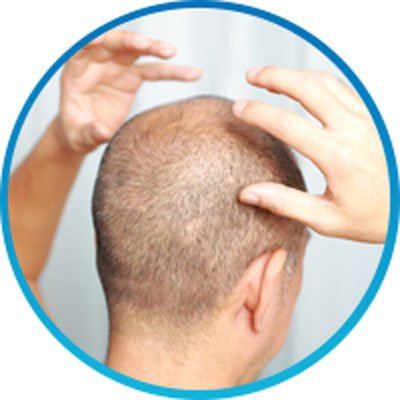 PRP Hair Restoration